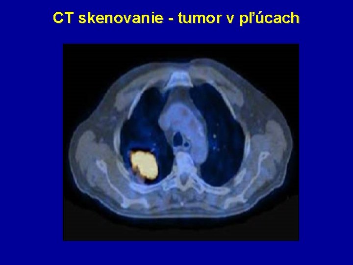CT skenovanie - tumor v pľúcach 