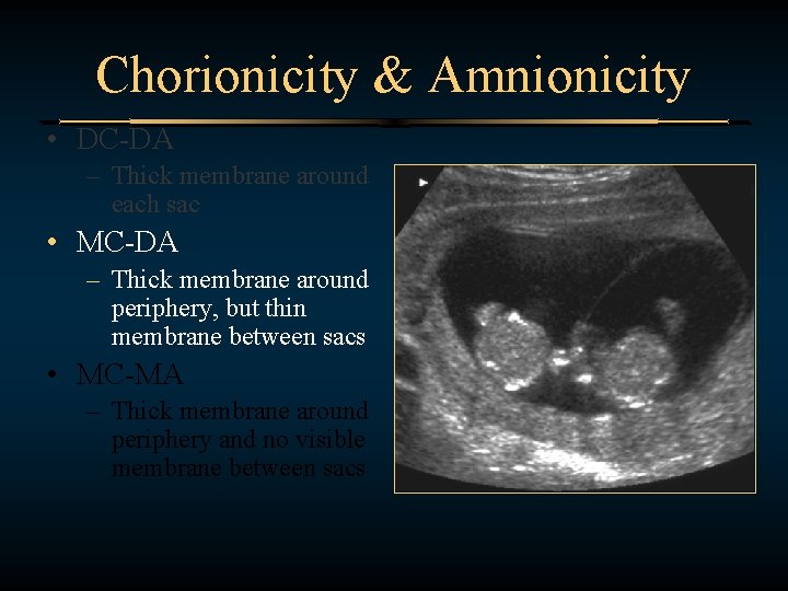 Chorionicity & Amnionicity • DC-DA – Thick membrane around each sac • MC-DA –