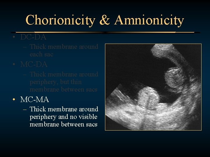 Chorionicity & Amnionicity • DC-DA – Thick membrane around each sac • MC-DA –