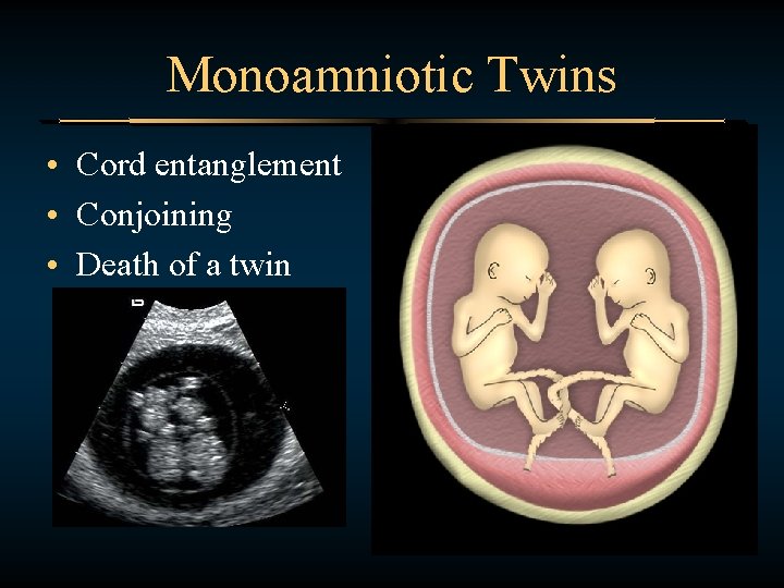 Monoamniotic Twins • Cord entanglement • Conjoining • Death of a twin 