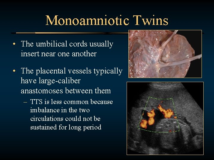 Monoamniotic Twins • The umbilical cords usually insert near one another • The placental