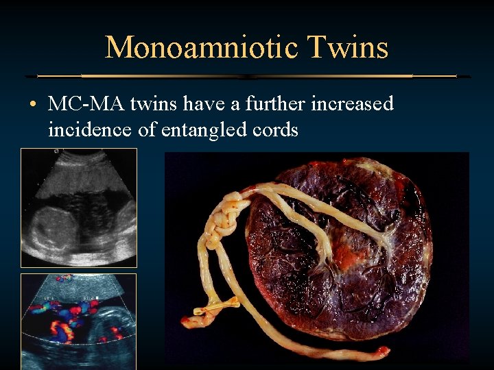 Monoamniotic Twins • MC-MA twins have a further increased incidence of entangled cords 