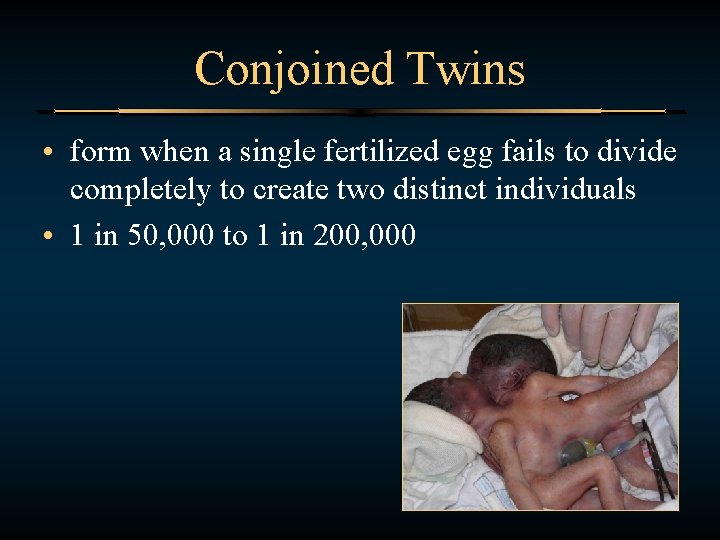 Conjoined Twins • form when a single fertilized egg fails to divide completely to