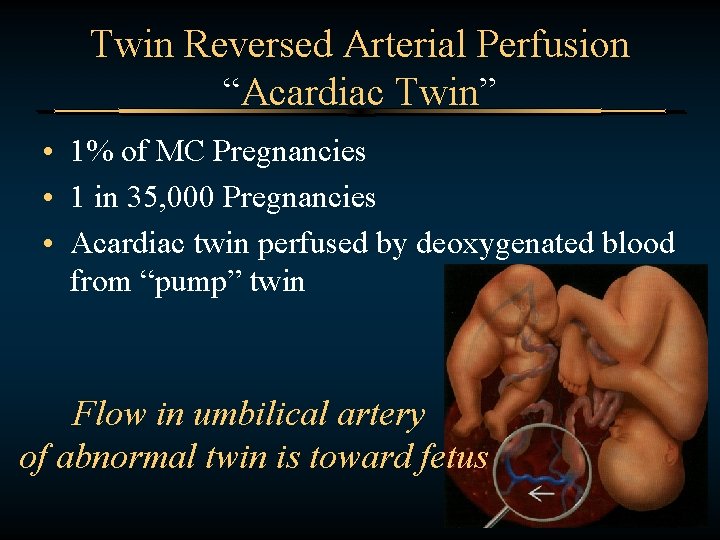 Twin Reversed Arterial Perfusion “Acardiac Twin” • 1% of MC Pregnancies • 1 in