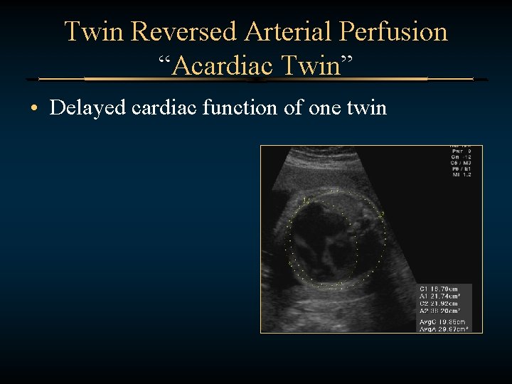 Twin Reversed Arterial Perfusion “Acardiac Twin” • Delayed cardiac function of one twin 