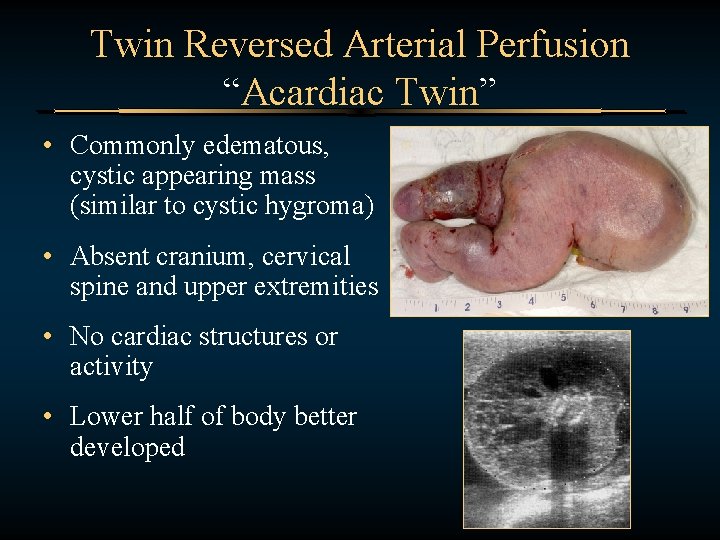 Twin Reversed Arterial Perfusion “Acardiac Twin” • Commonly edematous, cystic appearing mass (similar to