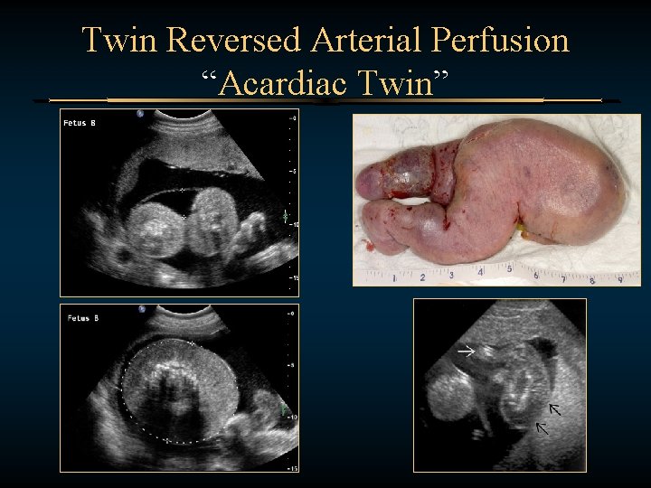 Twin Reversed Arterial Perfusion “Acardiac Twin” 