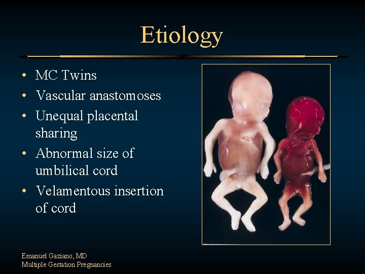 Etiology • MC Twins • Vascular anastomoses • Unequal placental sharing • Abnormal size
