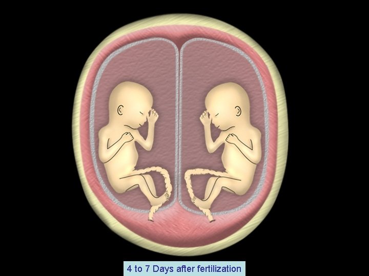 Emanuel Gaziano, MD Multiple Gestation Pregnancies 4 to 7 Days after fertilization 