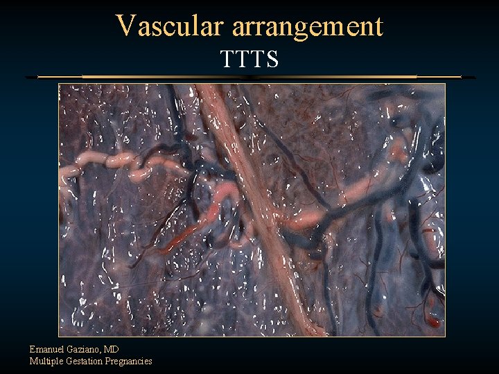 Vascular arrangement TTTS Emanuel Gaziano, MD Multiple Gestation Pregnancies 