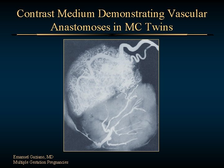 Contrast Medium Demonstrating Vascular Anastomoses in MC Twins Emanuel Gaziano, MD Multiple Gestation Pregnancies