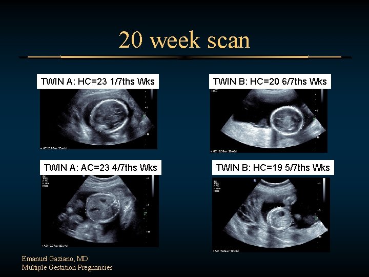20 week scan TWIN A: HC=23 1/7 ths Wks TWIN A: AC=23 4/7 ths