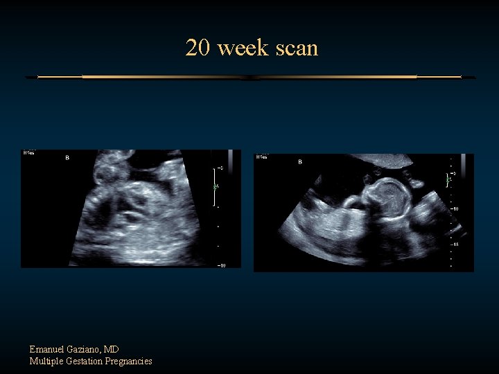  20 week scan Emanuel Gaziano, MD Multiple Gestation Pregnancies 