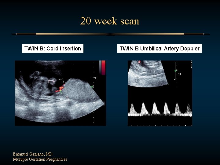 20 week scan TWIN B: Cord Insertion Emanuel Gaziano, MD Multiple Gestation Pregnancies TWIN