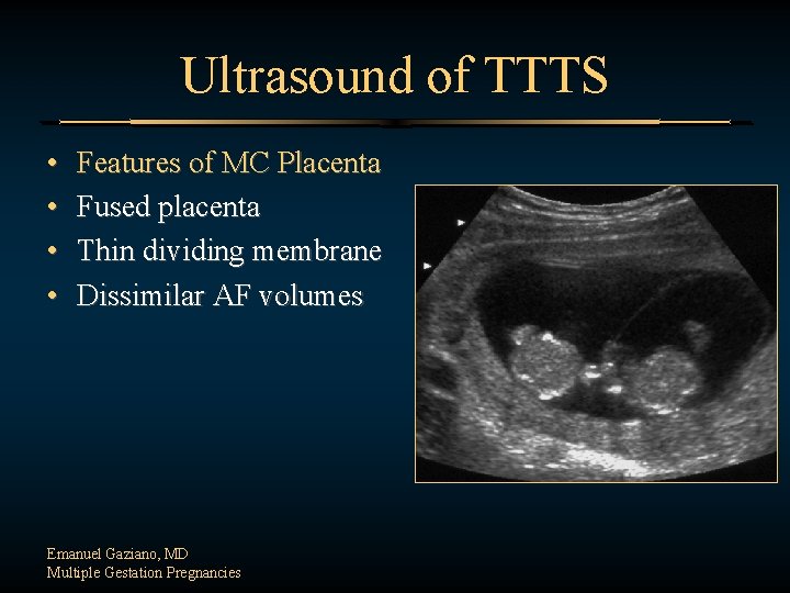 Ultrasound of TTTS • • Features of MC Placenta Fused placenta Thin dividing membrane