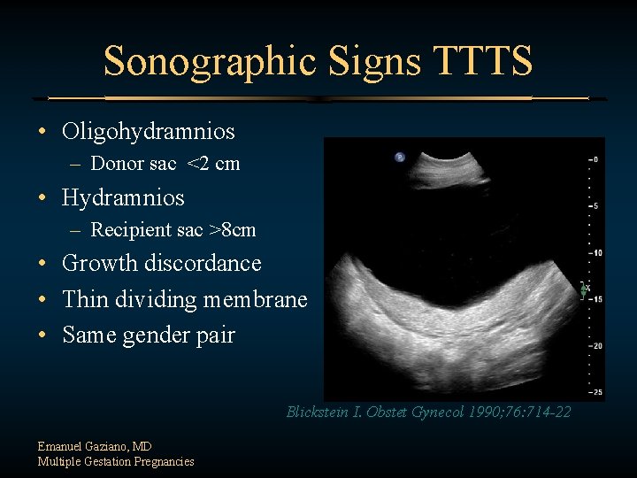 Sonographic Signs TTTS • Oligohydramnios – Donor sac <2 cm • Hydramnios – Recipient