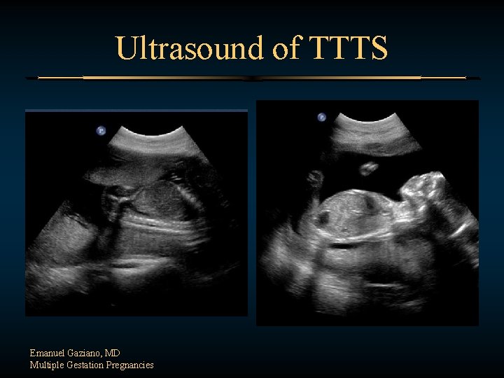 Ultrasound of TTTS Emanuel Gaziano, MD Multiple Gestation Pregnancies 