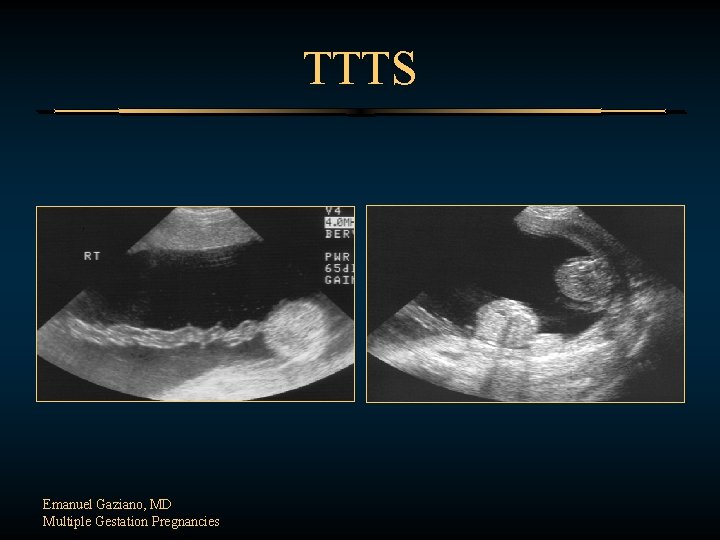 TTTS Emanuel Gaziano, MD Multiple Gestation Pregnancies 