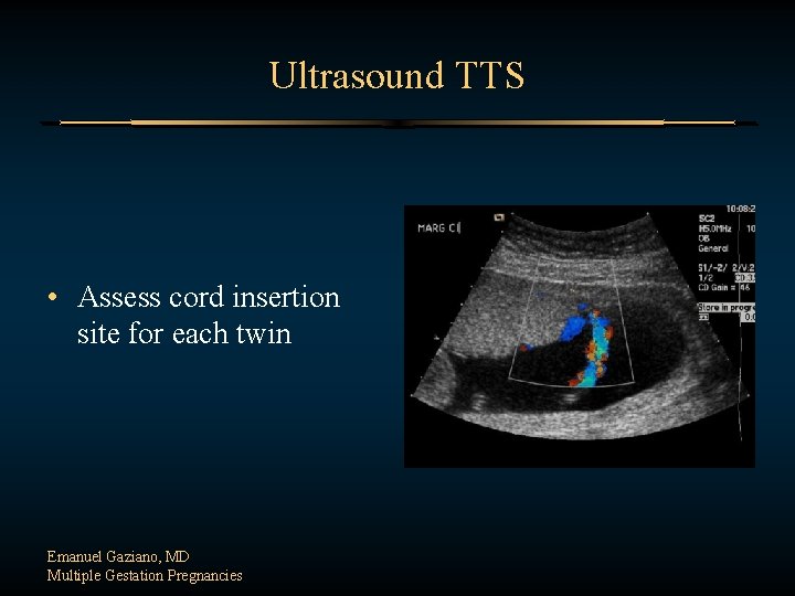 Ultrasound TTS • Assess cord insertion site for each twin Emanuel Gaziano, MD Multiple