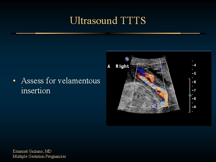 Ultrasound TTTS • Assess for velamentous insertion Emanuel Gaziano, MD Multiple Gestation Pregnancies 