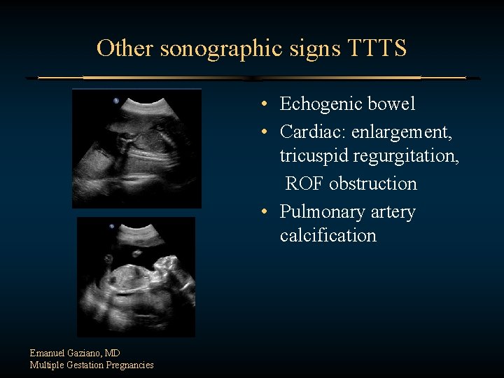 Other sonographic signs TTTS • Echogenic bowel • Cardiac: enlargement, tricuspid regurgitation, ROF obstruction