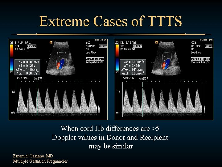 Extreme Cases of TTTS When cord Hb differences are >5 Doppler values in Donor