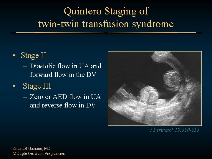 Quintero Staging of twin-twin transfusion syndrome • Stage II – Diastolic flow in UA