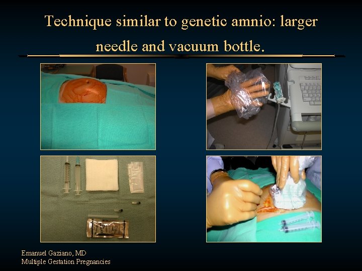 Technique similar to genetic amnio: larger needle and vacuum bottle. Emanuel Gaziano, MD Multiple