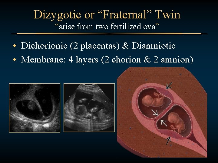 Dizygotic or “Fraternal” Twin “arise from two fertilized ova” • Dichorionic (2 placentas) &