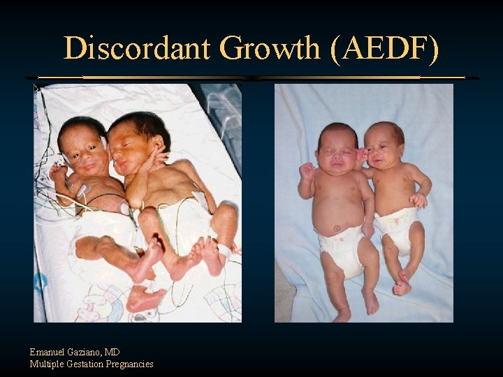 Discordant Growth (AEDF) Emanuel Gaziano, MD Multiple Gestation Pregnancies 