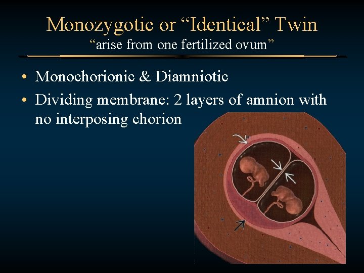 Monozygotic or “Identical” Twin “arise from one fertilized ovum” • Monochorionic & Diamniotic •