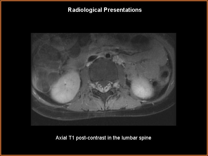 Radiological Presentations Axial T 1 post-contrast in the lumbar spine 