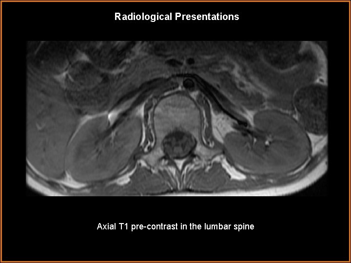Radiological Presentations Axial T 1 pre-contrast in the lumbar spine 