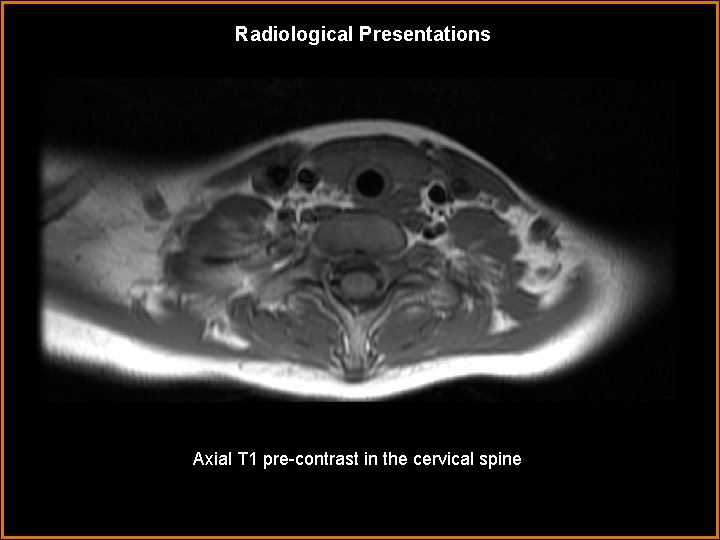 Radiological Presentations Axial T 1 pre-contrast in the cervical spine 