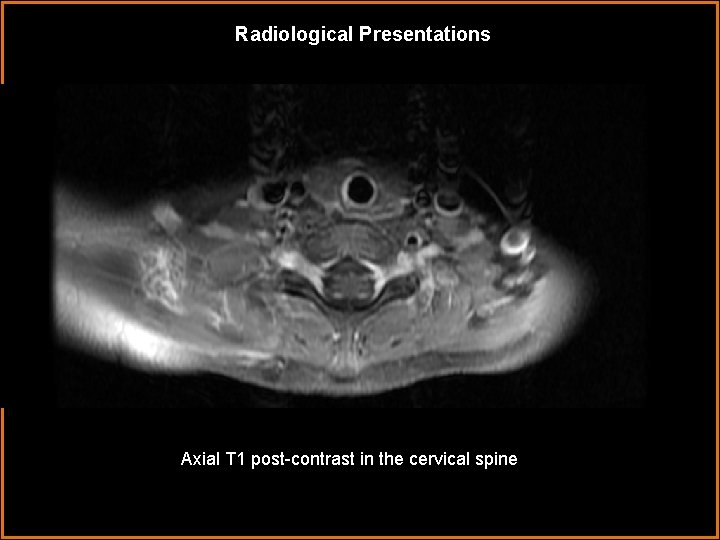 Radiological Presentations Axial T 1 post-contrast in the cervical spine 