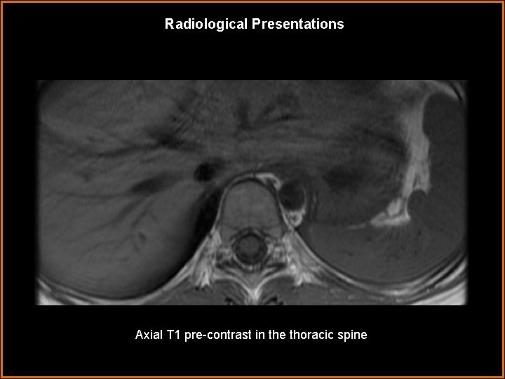 Radiological Presentations Axial T 1 pre-contrast in the thoracic spine 