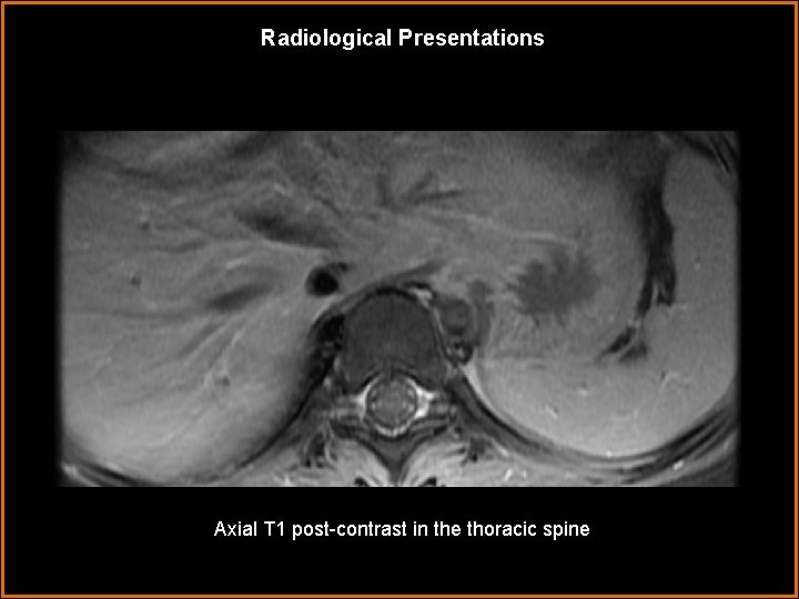 Radiological Presentations Axial T 1 post-contrast in the thoracic spine 