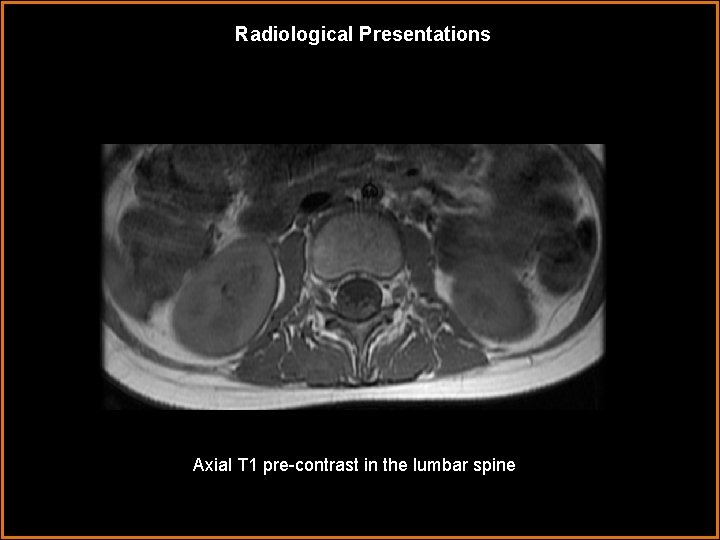 Radiological Presentations Axial T 1 pre-contrast in the lumbar spine = 