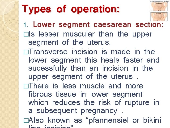 Types of operation: Lower segment caesarean section: �Is lesser muscular than the upper segment