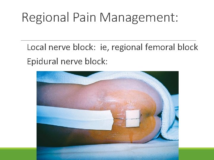 Regional Pain Management: Local nerve block: ie, regional femoral block Epidural nerve block: 