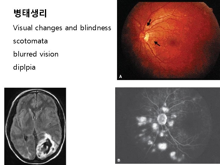 병태생리 Visual changes and blindness scotomata blurred vision diplpia 