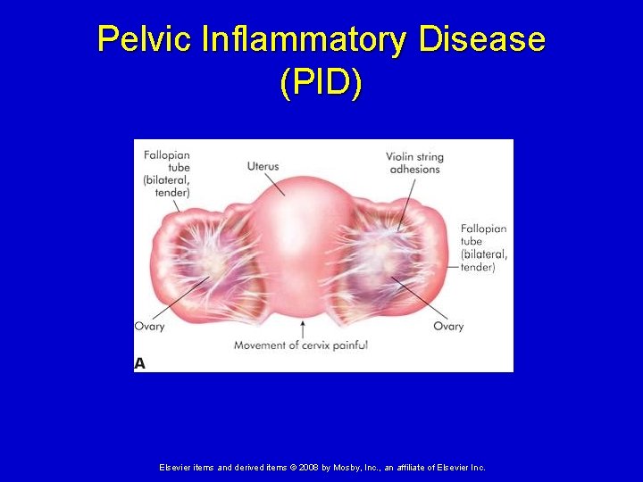 Pelvic Inflammatory Disease (PID) Elsevier items and derived items © 2008 by Mosby, Inc.