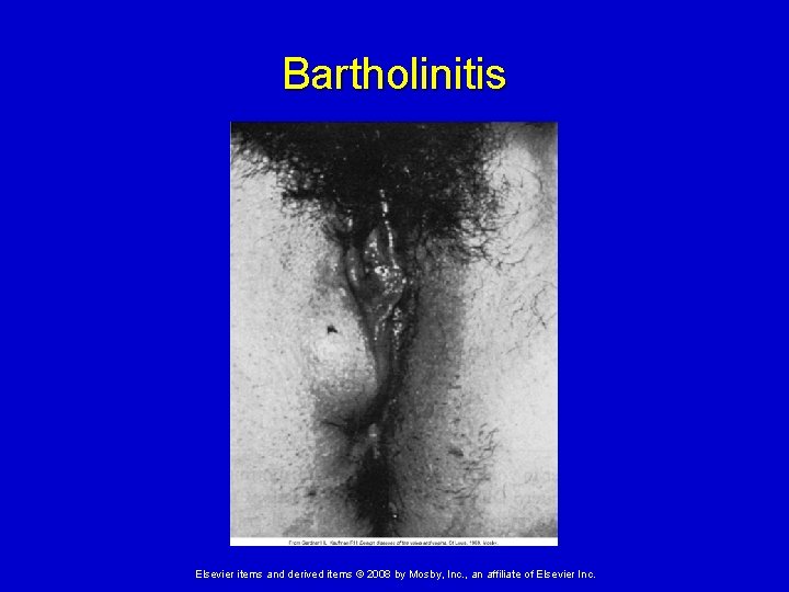 Bartholinitis Elsevier items and derived items © 2008 by Mosby, Inc. , an affiliate