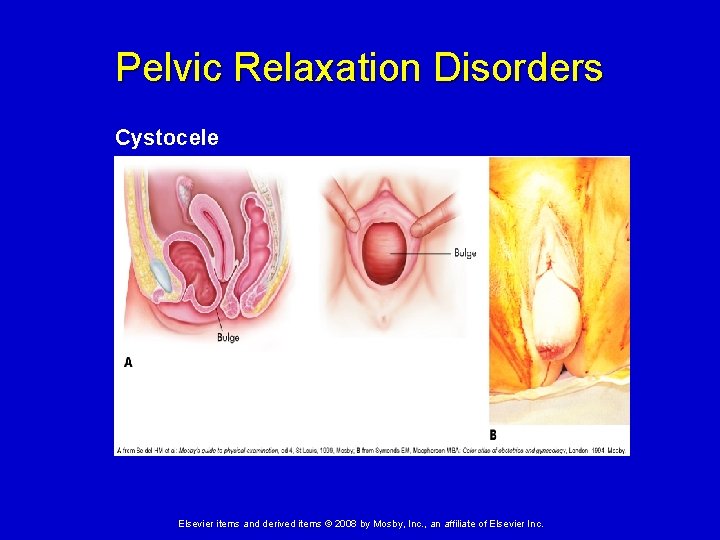 Pelvic Relaxation Disorders Cystocele Elsevier items and derived items © 2008 by Mosby, Inc.