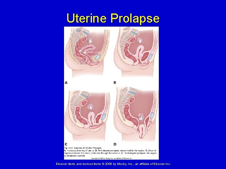 Uterine Prolapse Elsevier items and derived items © 2008 by Mosby, Inc. , an