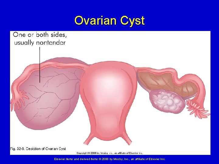 Ovarian Cyst Elsevier items and derived items © 2008 by Mosby, Inc. , an
