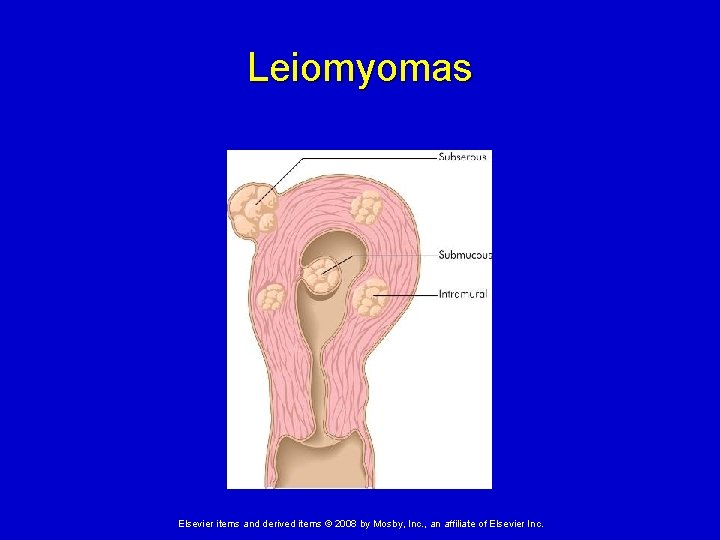 Leiomyomas Elsevier items and derived items © 2008 by Mosby, Inc. , an affiliate