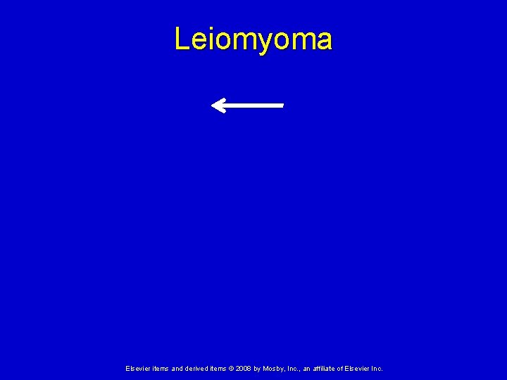 Leiomyoma Elsevier items and derived items © 2008 by Mosby, Inc. , an affiliate
