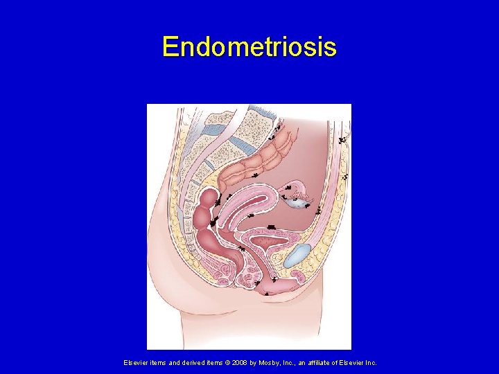 Endometriosis Elsevier items and derived items © 2008 by Mosby, Inc. , an affiliate