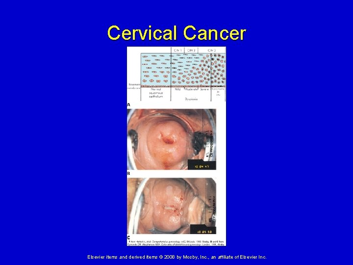 Cervical Cancer Elsevier items and derived items © 2008 by Mosby, Inc. , an